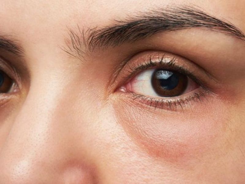 Phù nề mặt hoặc sưng bọng mắt